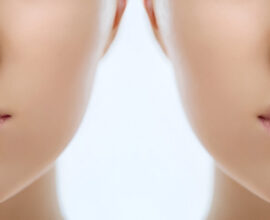 lip lift