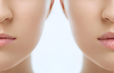 lip lift