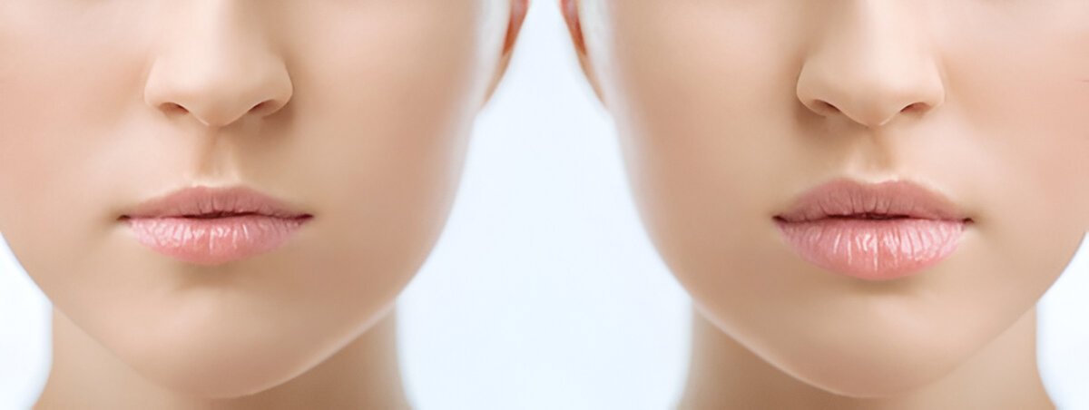 lip lift